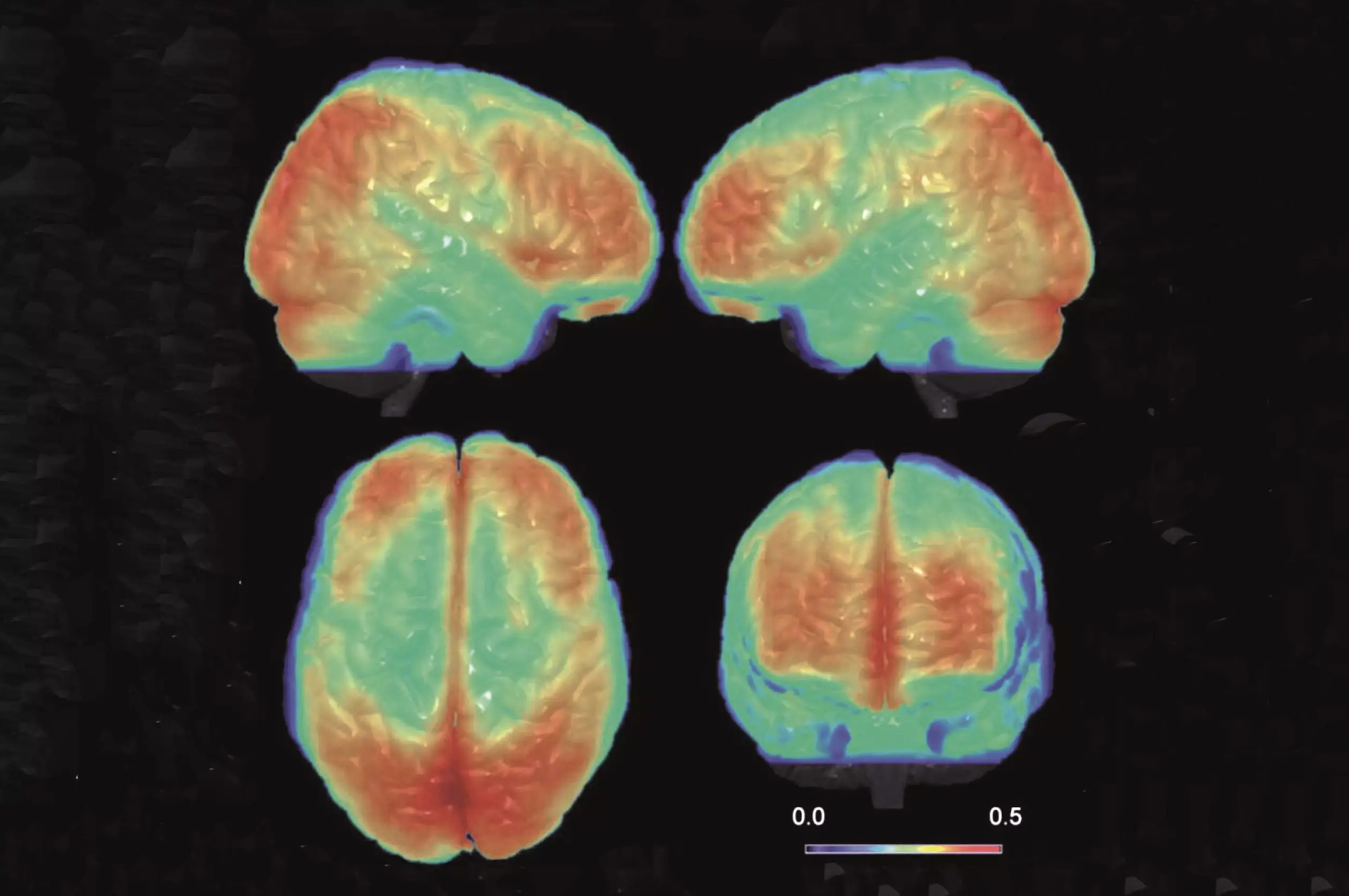 the differences between a bipolar brain and a normal brain_a7da92fc feb7 45f9 81fd c82f77b95b8c