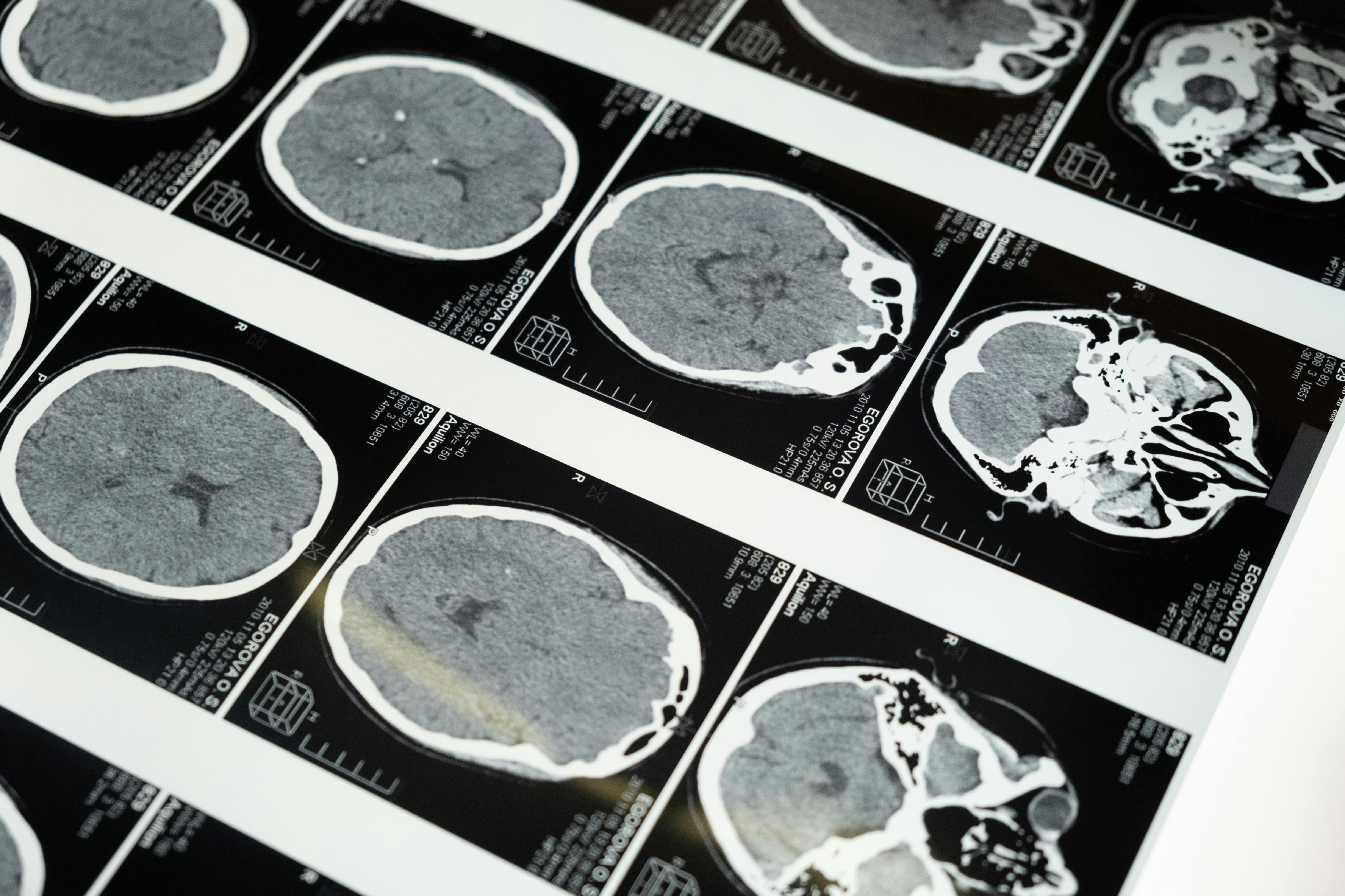 the differences between a bipolar brain and a normal brain_d0c81d11 6182 4970 923a abc364dccd7a